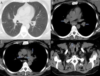 Case report: Thyroid sarcoidosis as a rare localization of the disease: Report of two cases and review of the literature